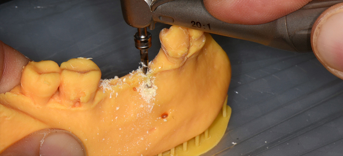 Pianificazione chirurgica su modello anatomico mandibolare stampato 3D di un’atrofia ossea orizzontale